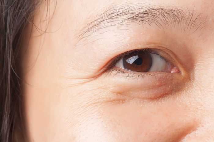 Giảm túi mỡ mắt