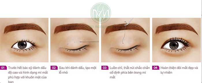 Bấm mí bị hỏng