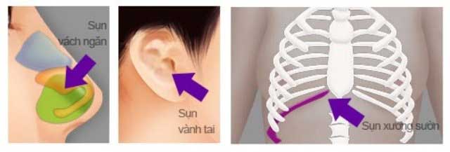 Nâng mũi bằng sụn sườn