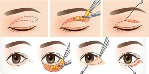 Cắt mắt 2 mí có nguy hiểm