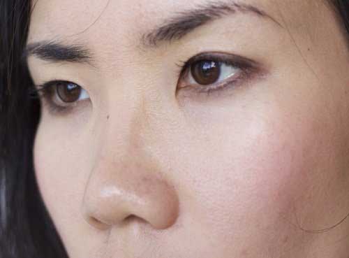 Làm sao để giảm sụp mí mắt
