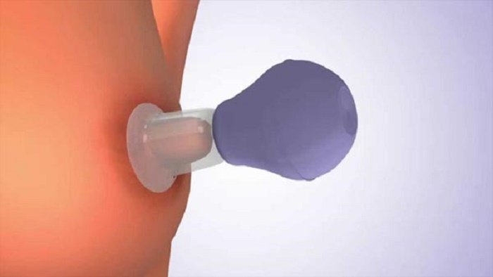 Núm vú bị tụt vào trong làm thế nào