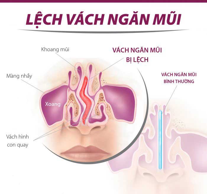 Phẫu thuật vách ngăn mũi bao nhiêu tiền