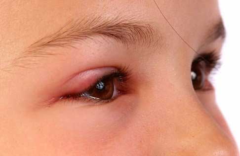Sụp mí mắt trái