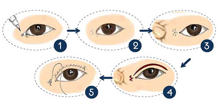 Mở rộng góc mắt ở đâu đẹp