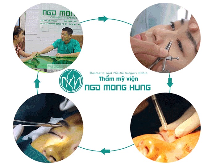 Mở rộng góc mắt ở đâu đẹp