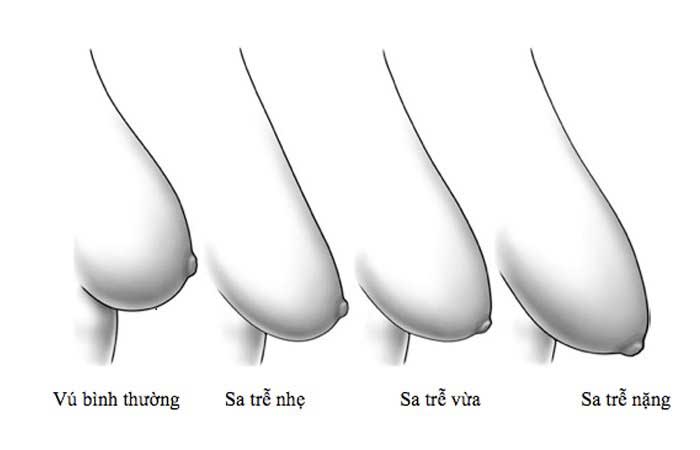 Làm sao biết ngực bị xệ