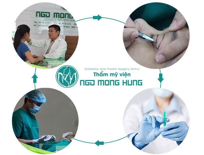 Có nên nâng mí mắt