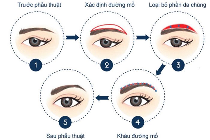 Miếng dán nâng mí mắt