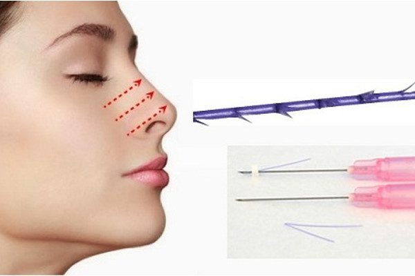 Nâng mũi bằng chỉ