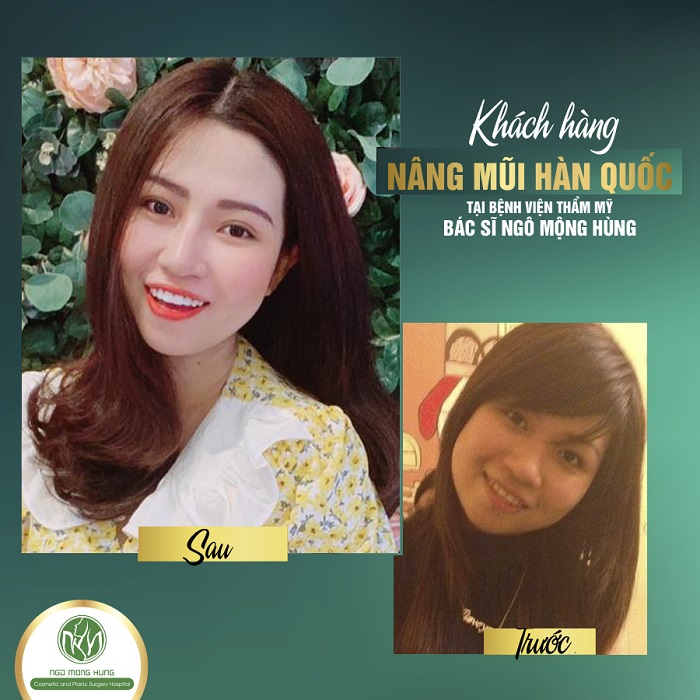 Nâng mũi Hàn Quốc có đau không Nâng mũi Hàn Quốc có đau không