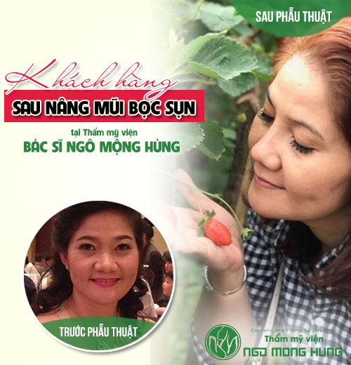 Nâng mũi bằng sụn sườn