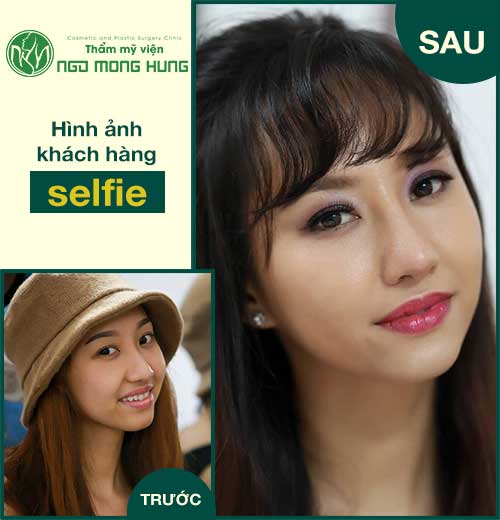 Em muốn thu gọn cánh mũi