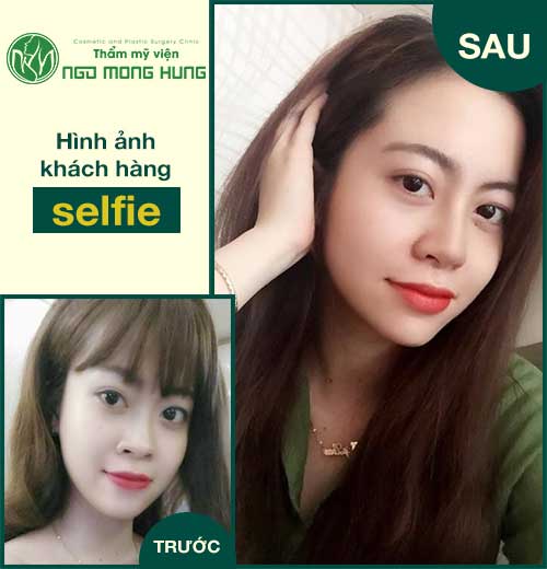 Thu nhỏ đầu mũi và cánh mũi
