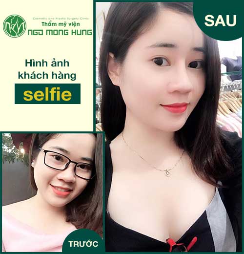 Thu nhỏ đầu mũi ở đâu đẹp