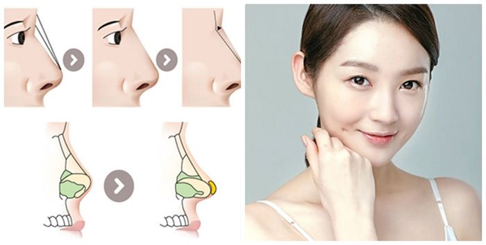 Nhược điểm nâng mũi bọc sụn