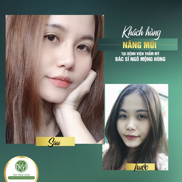 Nâng mũi không phẫu thuật là gì