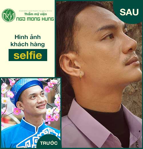 Thu nhỏ đầu mũi webtretho