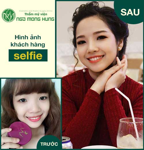 Phẫu thuật thu gọn đầu mũi hết bao nhiêu tiền