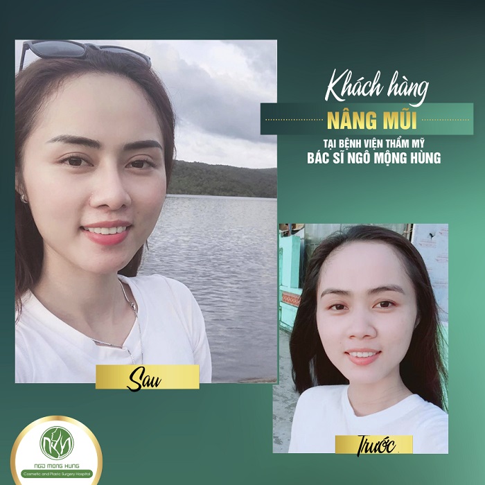 Lỗ mũi hếch lên