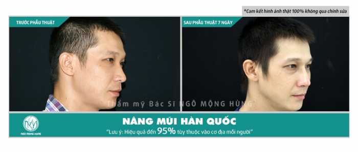 Nâng mũi nam giới