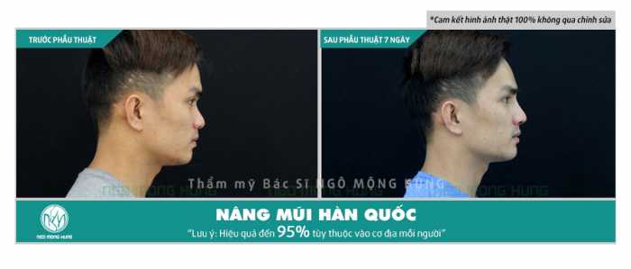 Nâng mũi nam giới