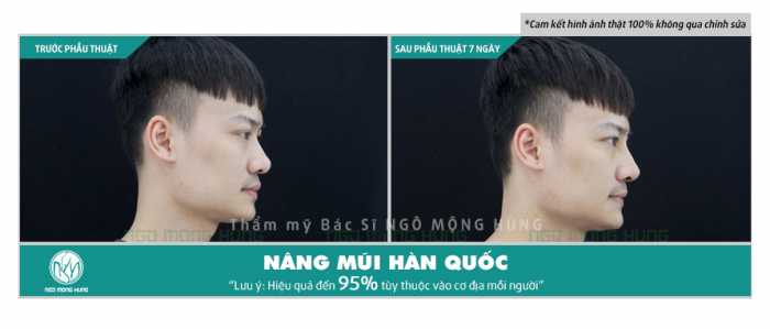 Nâng mũi nam giới
