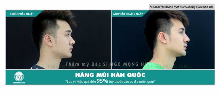 Nâng mũi nam giới