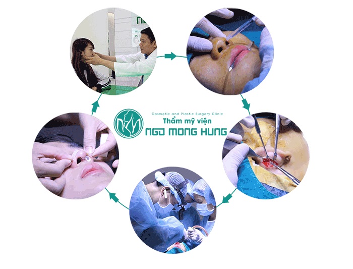 Nâng mũi bằng chất làm đầy aquamid