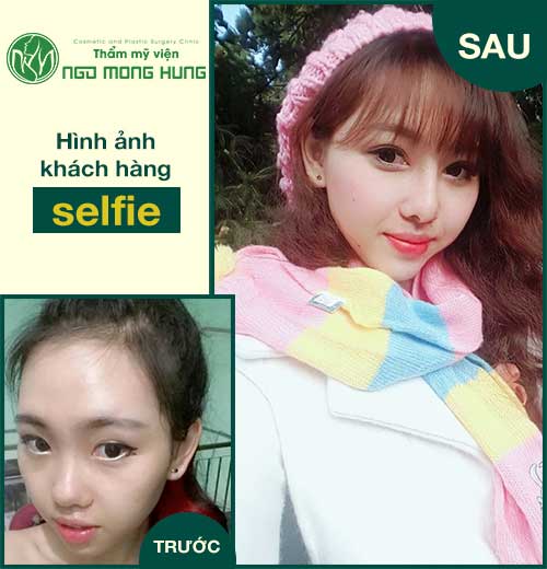 Thu nhỏ đầu mũi ở đâu đẹp