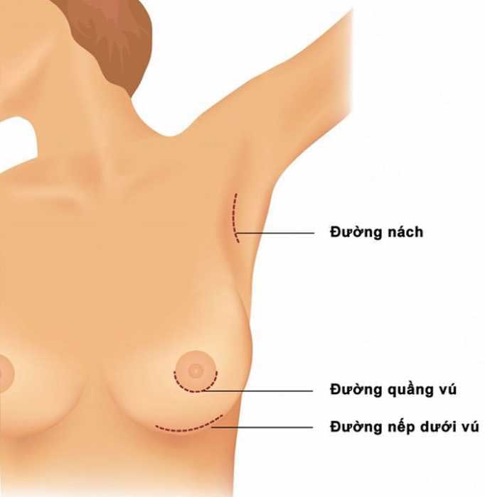 Nâng ngực bằng đường nào tốt nhất