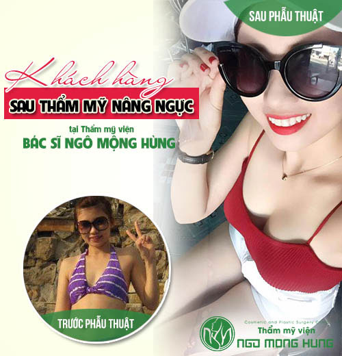 Nâng ngực an toàn giá rẻ Nâng ngực an toàn giá rẻ