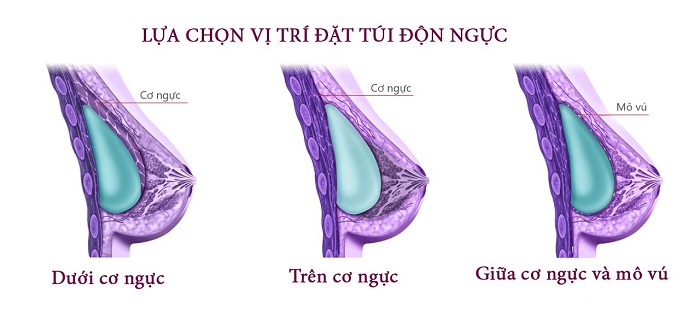 Nâng ngực có ảnh hưởng đến việc cho con bú