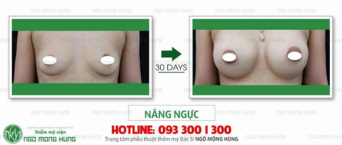 Nâng ngực đẹp