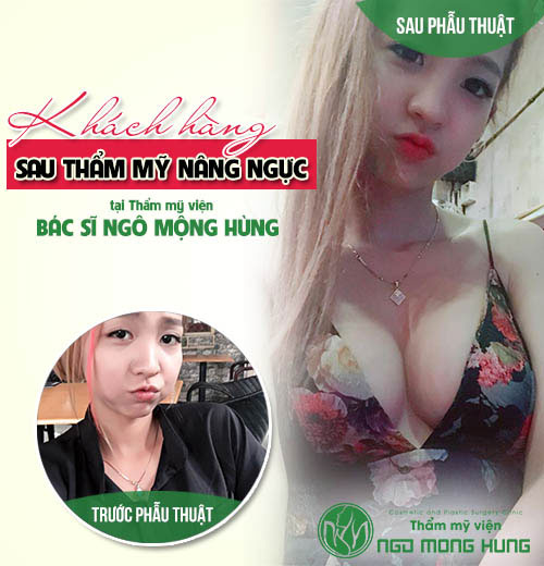 Nâng ngực giá bao nhiêu