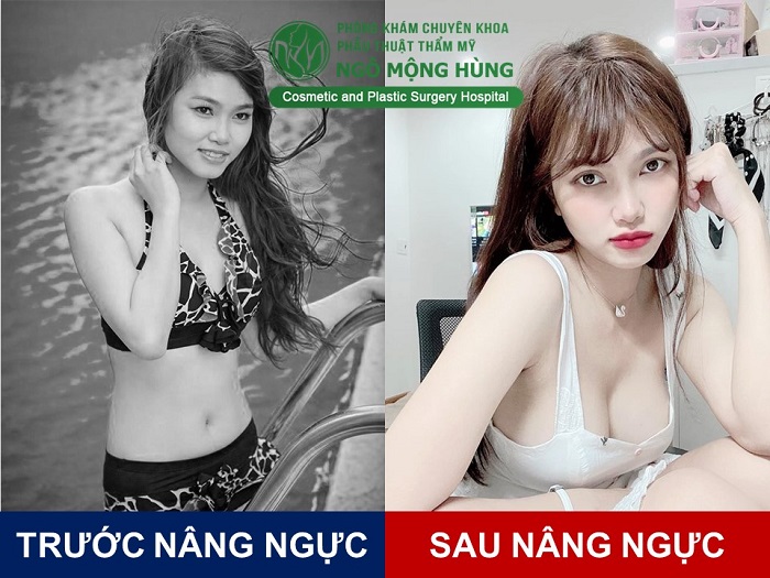 Nâng ngực giá bao nhiêu
