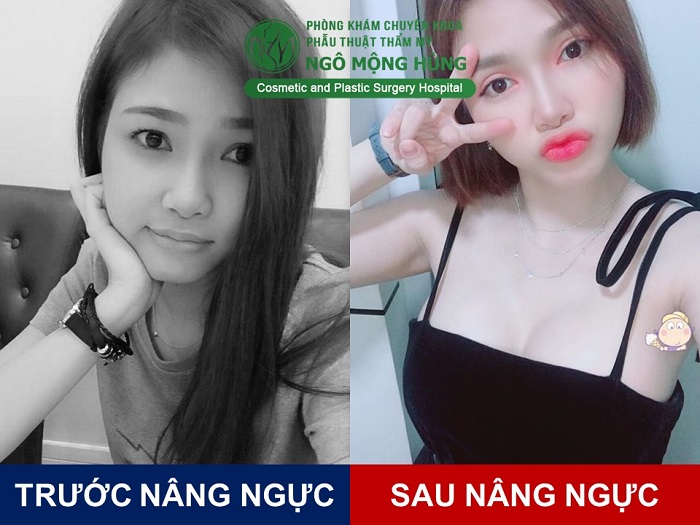Nâng ngực giá bao nhiêu
