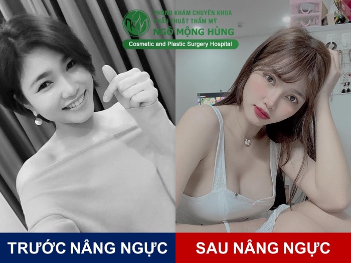 Nâng ngực giá bao nhiêu