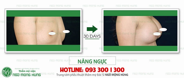 Nâng ngực Hàn Quốc