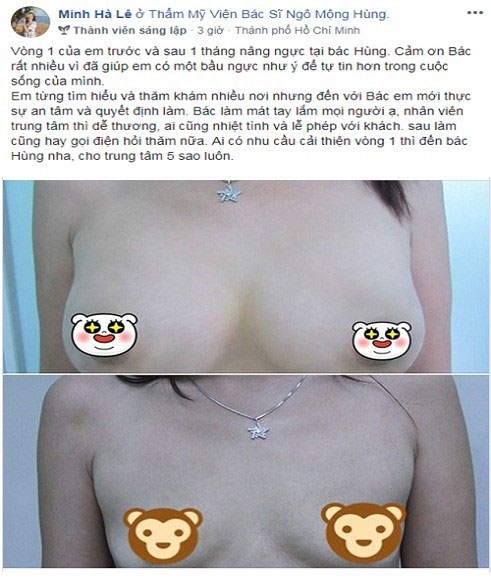 Nâng ngực hết bao nhiêu tiền