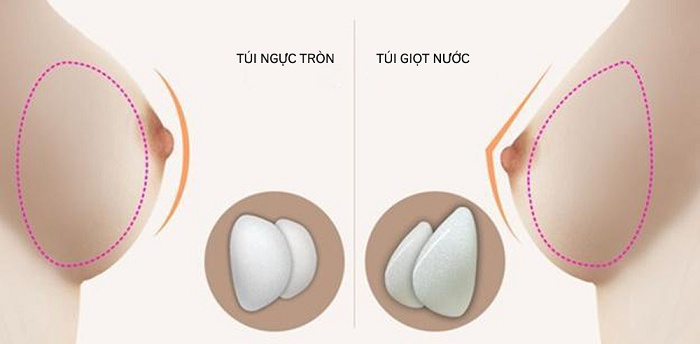 Nâng ngực có tự nhiên không