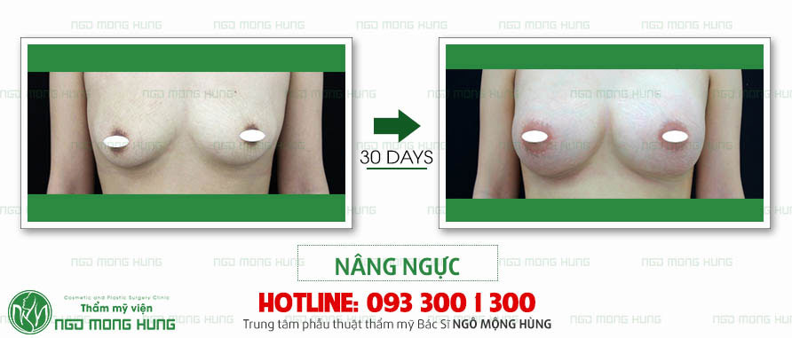 Nâng ngực hình giọt nước