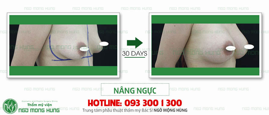 Nâng ngực hình giọt nước