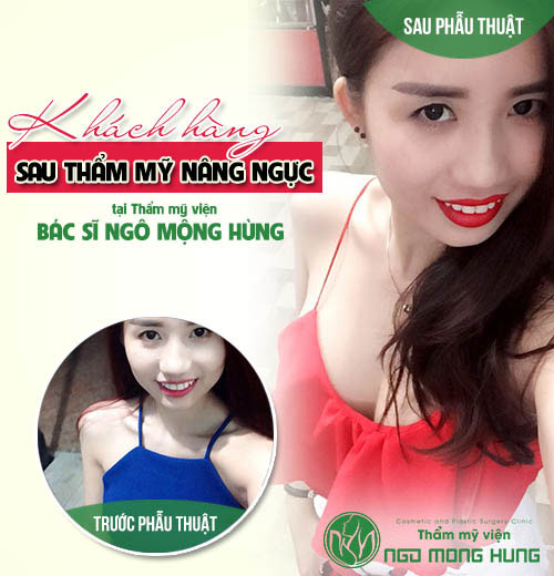 Nâng ngực không phẫu thuật