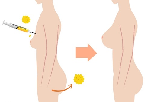 Nâng ngực không phẫu thuật