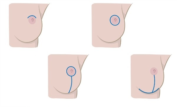 Vì sao ngực xệ