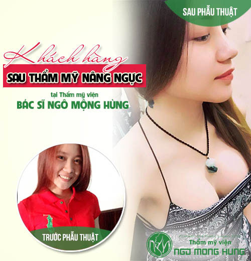 Nâng ngực webtretho Nâng ngực webtretho