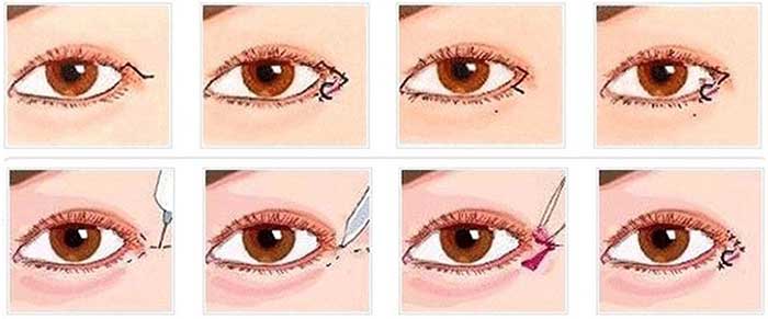 Mắt bị xếch
