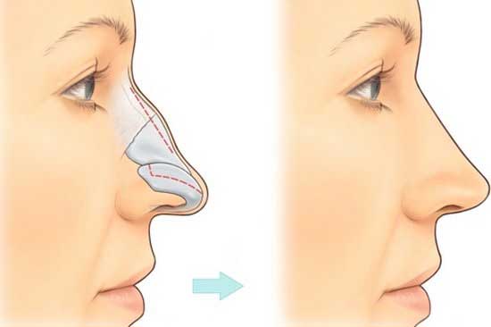 Nâng mũi gồ bọc sụn