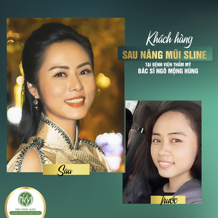 Phẫu thuật nâng cao sóng mũi